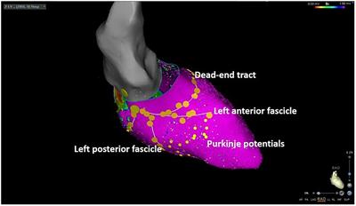 Catheter ablation in patients with ventricular fibrillation by purkinje de-networking